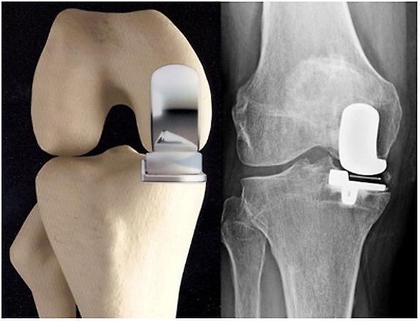 Röntgenfoto van een halve knieprothese