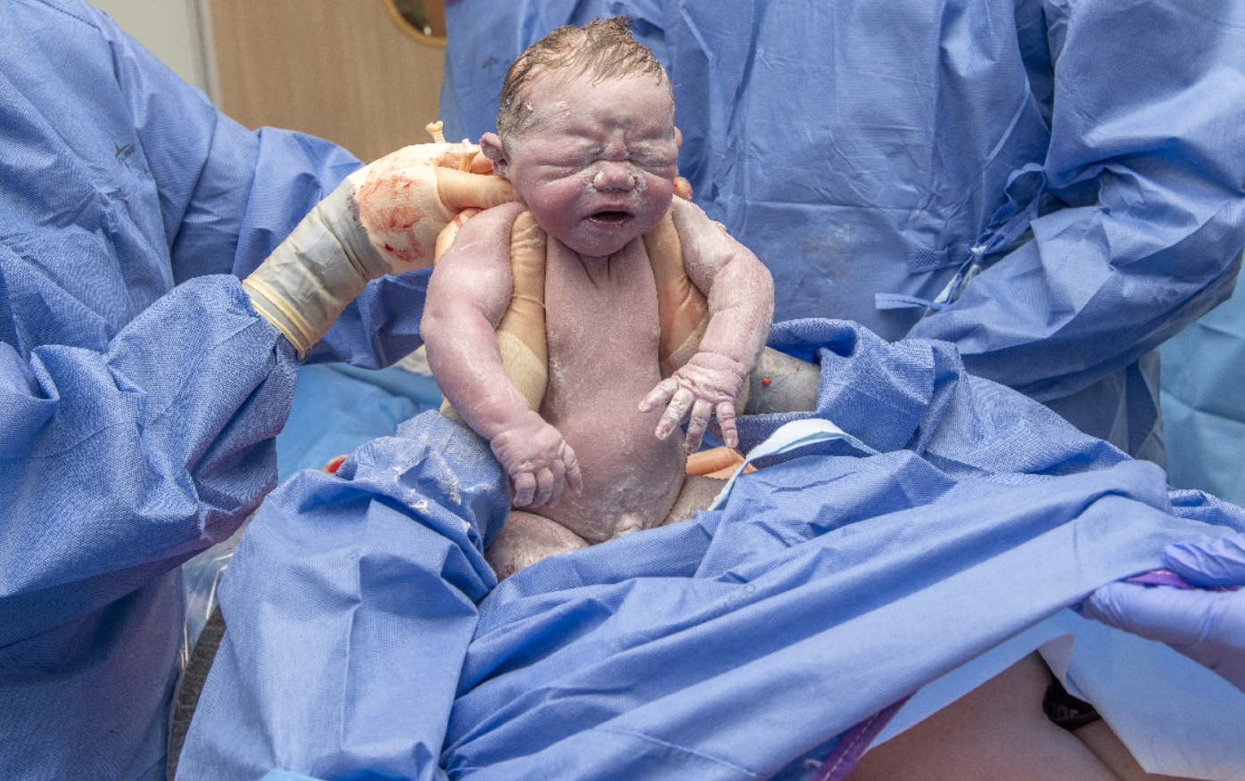 Baby wordt uit de buik gehaald door moeder met hulp van operatie-collega's